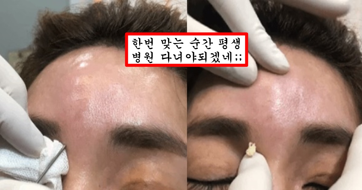 필러 맞은 사람들은 무조건 10년안에 해야한다는 녹이는 주사 맞아도 답 없는 필러 제거 영상